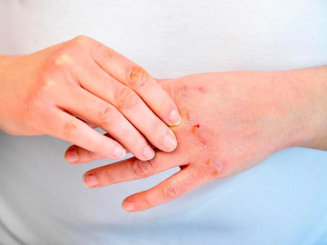 Pensi di avere una dermatite? Ecco la differenza fondamentale con l&#8217;eczema che devi conoscere